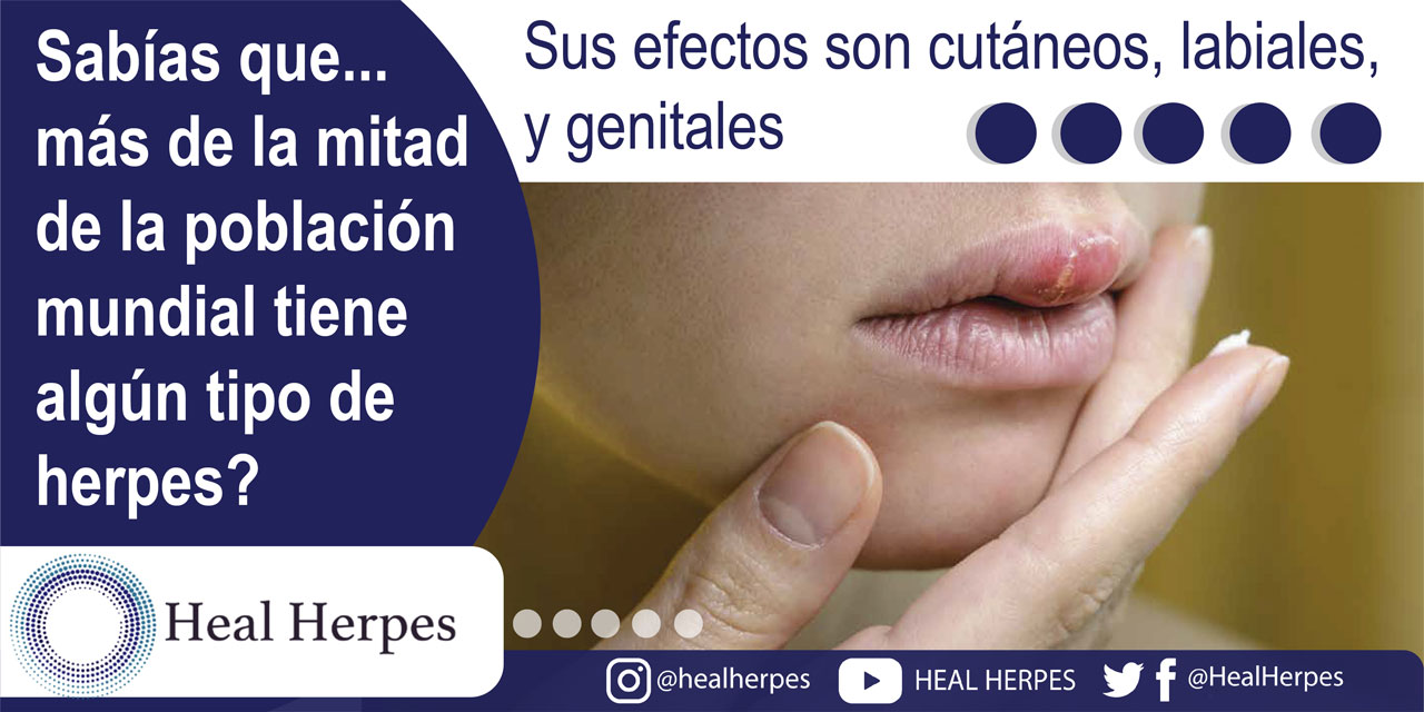 Herpes labial